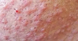 Может ли из за молочницы быть прыщи на теле