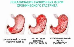 При раке желудка пахнет изо рта