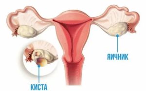 Что такое киста в яичниках женских половых органах