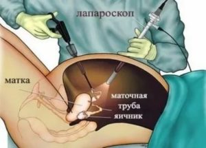 Когда можно кушать после операции киста яичника