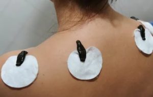 Куда ставят пиявки при лечении кисты яичника