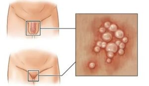 Чешутся половые губы хлоргексидин