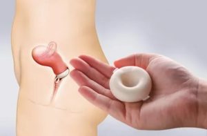 Мазь для введения во влагалище с тампоном