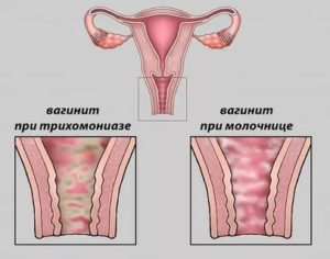 Осложнения при кандидозном кольпите