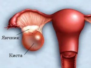 Что такое фиброзная стенка кисты яичника