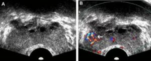 Гипоэхогенное образование предстательной железы это рак или нет
