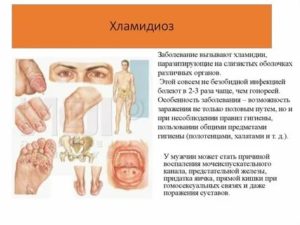 Всегда ли хламидиоз приводит к бесплодию