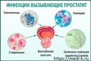 Чем отличается хронический от острого простатита