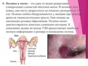 Что такое киста шейки матки и полипы как ее лечить