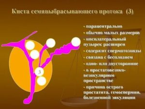 Что такое киста семявыносящего протока