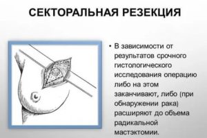 Обезболивающие таблетки после операции на молочной железе