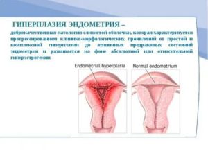 Эндометриоз и гиперплазия матки это одно заболевание или нет