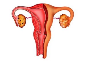 Чем лечить атрофический вагинит постменопаузе