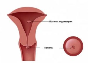 Может ли рассосаться полип эндометрия при менопаузе