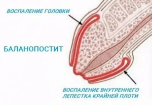 Эрозия головки и крайней плоти лечение мази