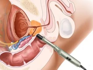 Что такое дренирование предстательной железы