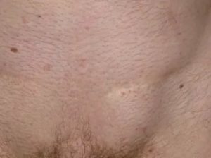 Как лечить кисту в паху у женщин