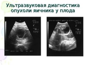 Что такое киста яичника у плода в 32 недели
