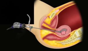 Гистероскопия мва эндометрия что это