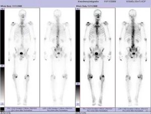 Сцинтиграфия костей скелета при раке молочной железы