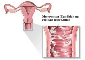Молочница творожистые выделения лечение свечи