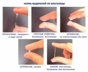 Молочница перед подсадкой эмбрионов
