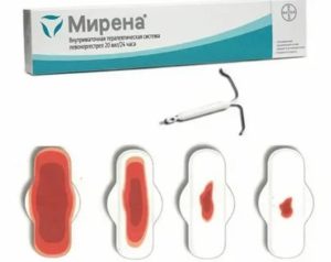 Спираль мирена при эндометриозе отзывы врачей специалистов при эндометриозе