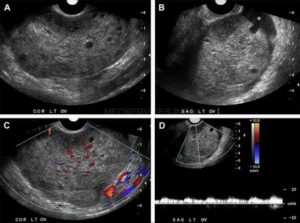 Перекрут яичника по узи признаки