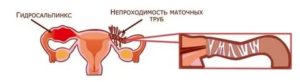 Женское бесплодие трубного происхождения что это такое