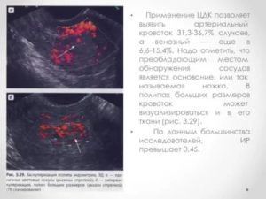 Узи с кровотоком в эндометрии для чего делают