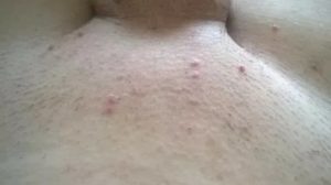 Может ли из за молочницы быть прыщи на теле