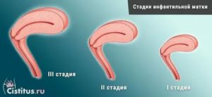 Размеры инфантильной матки при узи