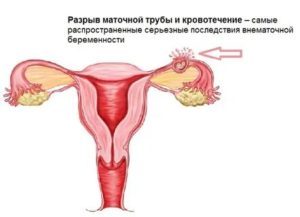 Что может болеть во время месячных маточные трубы