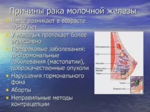 Потеря аппетита при раке молочной железы