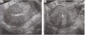 Вмс в полости матки на узи