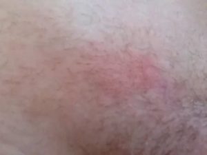 Мазь если чешется лобок