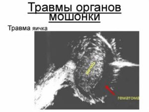 Препарата при ушибе мошонки