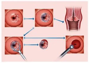 Что нельзя делать после прижигания кисты шейки матки что это такое
