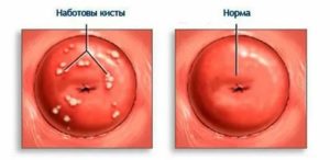 Что такое эндометриоз и кисты шейки матки