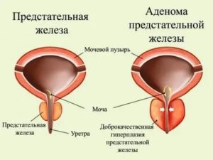 Что такое аденома простаты у мужчин и чем она опасна