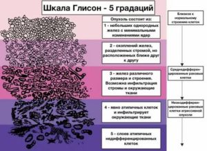 Ацинарная аденокарцинома предстательной железы 9 баллов по глисону прогноз