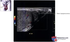 Нормальные размеры придатка яичка на узи