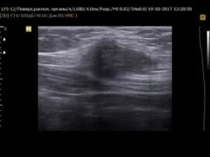 Эндометриоз послеоперационного рубца передней брюшной стенки операция