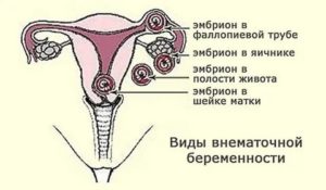 Могут ли не идти месячные при внематочной беременности на ранних сроках