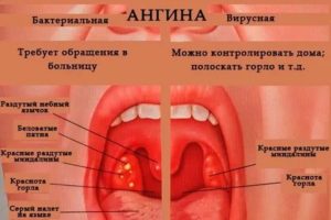 Кандидозная ангина у детей комаровский
