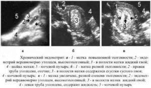 Признаки хронического метрита на узи