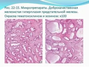 Доброкачественная гиперплазия предстательной железы микропрепарат