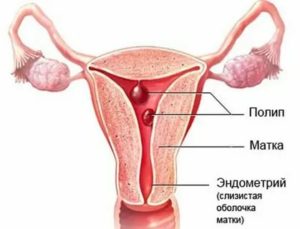 Антибиотики при полипах эндометрия