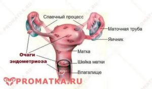 Беременность при эндометриозе лечение жанином