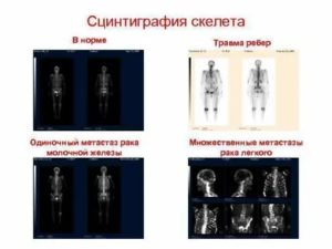 Остеосцинтиграфия при раке молочной железы